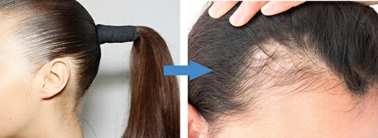 Traction Alopecia