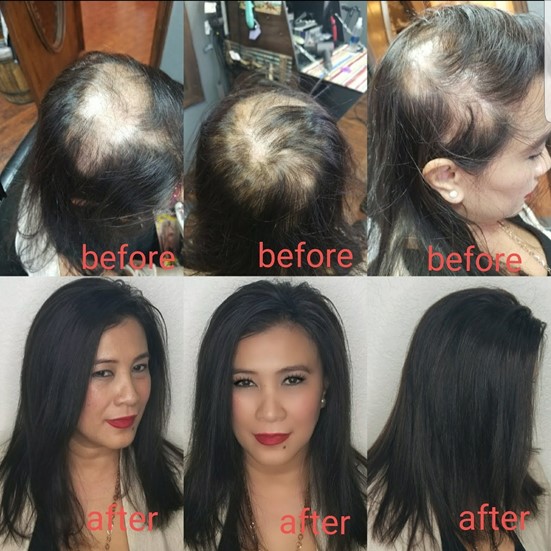 Hair Integration System - Before & After